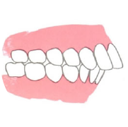奥歯の咬み合わせの問題