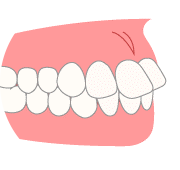 前歯の傾斜角度の問題