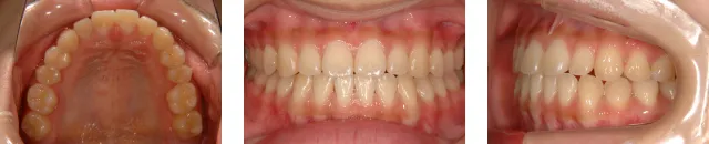 治療後3