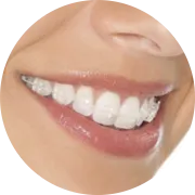 矯正装置って？